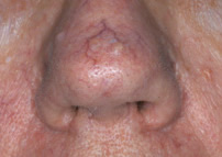 vein removal nose before Chester new jersey
